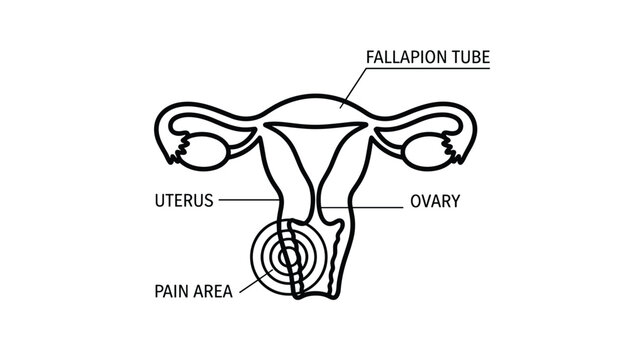 Female reproductive system diagram outlining the uterus, ovaries, and fallopian tubes with a highlighted pain area at the cervix.