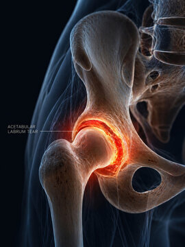 Acetabular labrum tear and hip joint damage medical illustration