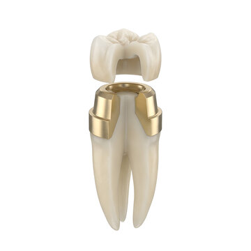 Highly Detailed 3D Render of a Telescopic Dental Crown System, Suitable for Science Education, Isolated on a White Background