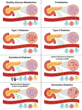 Detailed infographic explaining diverse diabetes types, glucose metabolism, prediabetes, and related endocrine conditions