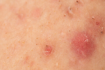 Fototapeta premium Dermatology concept with acne skin pores. Skin rash texture with acne. Inflamed skin bumps acne macro. Irritated acne skin.