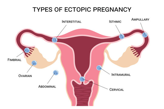 Types of ectopic pregnancy in the female reproductive system. Fimbrial, ovarian, abdominal, tubal, cervical locations. Ideal for gynecology, healthcare education. Vector medical illustration
