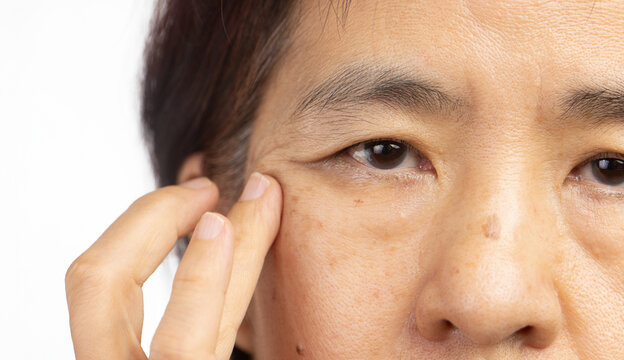 Flabby and wrinkled skin on senior woman face.