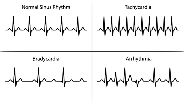 Heart rate monitor rhythms with normal sinus rhythm and abnormalities