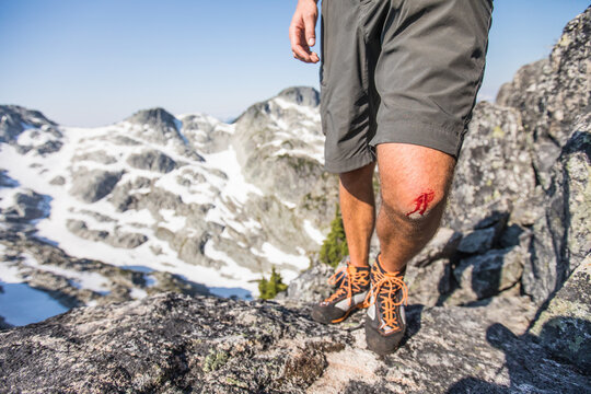 Hiker with a bleeding scraped knee in mountains