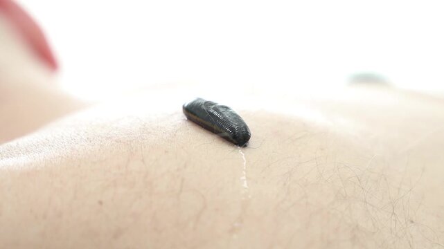 Hirudotherapy treatment with leeches at a medical clinic