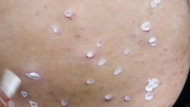 Horizontal close up video of cotton swab applying white medical cream on chickenpox skin rash, treatment of itchy varicella blisters and red pimples on body,  dermatology virus care concept.