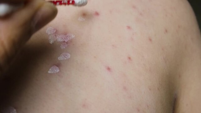 Horizontal macro video of medical cotton stick applying white zinc lotion on chickenpox virus skin rash, treating painful red spots, inflamed blisters and itchy varicella pimples on body.