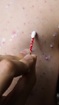 Vertical close up video of chickenpox skin blisters being treated with white soothing zinc lotion on cotton stick, dermatology care for viral varicella rash, itching pimples and red spots on body.