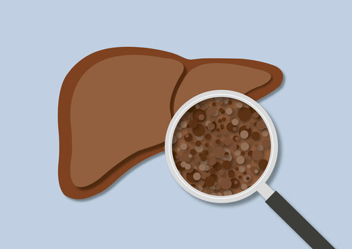 Liver cirrhosis, illustration