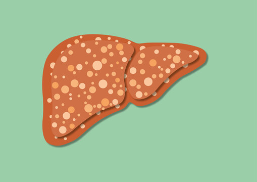 Fatty liver disease, illustration
