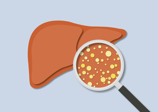 Fatty liver disease, illustration