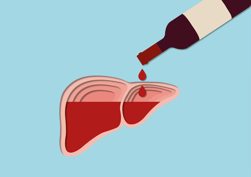 Alcoholic liver damage, conceptual illustration