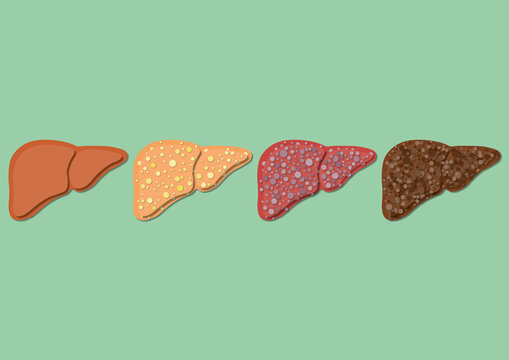 Liver cancer, illustration