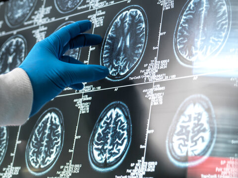 Gloved hand points to brain MRI scans displayed on a screen with medical data annotations.