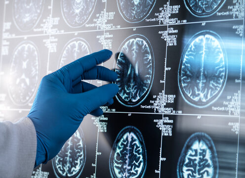 Gloved hand examining brain MRI scans on a lightbox, showcasing detailed brain images.