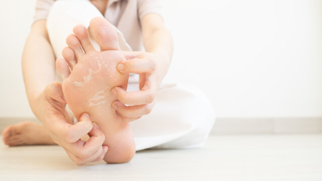 Woman scratching itchy feet that are peeling and cracked. Cause of itchy include athlete's foot (fungal infection), dermatitis (eczema), dry skin, dehydration or sweaty feet. Health care concept.