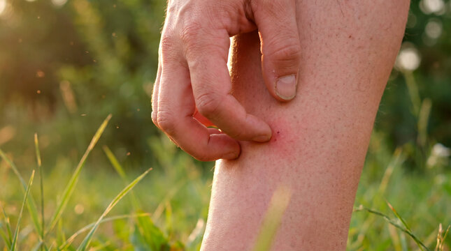 Close-up of a person scratching an insect bite on their leg outdoors