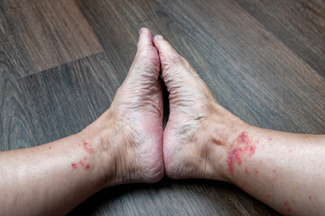 Naklejka premium Red rash on the interior ankles of a woman with a shallow depth of field