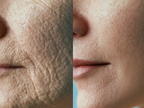 Extreme close-up before and after peptide treatment comparison of mature skin texture. Deep wrinkle smoothing and pore refinement dermatology results concept.