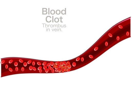 Blood clotting, thrombosis is a natural process the body performs to stop bleeding and repair injuries.Hardening, clogged arteries. Coronary, circulatory disease. Illustration vector