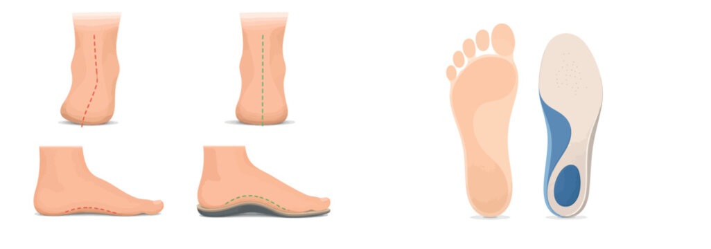 Vsai feet correcting flat foot pronation with orthopedic insoles