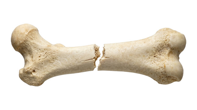 Broken human femur bone realistic medical anatomy specimen isolated on transparent background science.
