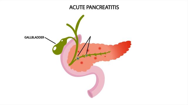 Medical vector animation showing pancreatic inflammation caused by duct obstruction and calculi. Educational healthcare concept illustrating digestive complications, abdominal discomfort