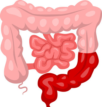 Bowel Surgery abdominal perineal resection