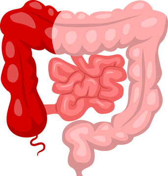Bowel Surgery right hemicolectomy