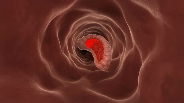 Appendix Anatomy with Lymphoid Hyperplasia and Blocked Lumen for Appendicitis Education