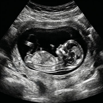 Second-Trimester Obstetric Ultrasound