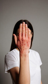 Woman holding hand with eczema rash covering skin. Symptoms of dermatitis or allergy on hand. Dermatological disease, skin irritation, medical concept for treatment and skin care.