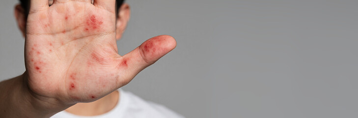 Fototapeta premium Man showing hand with rash symptoms of dermatological disease. Skin allergy on palm and thumb. Clinical dermatology examination, allergic reaction, eczema or dermatitis health problem.