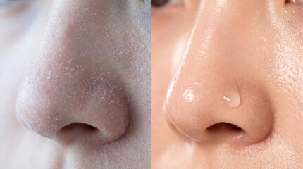 Fototapeta premium Dry nose flaky skin hydration smooth texture healthy skincare close up transformation before and after facial care moisture improvement