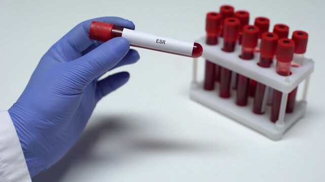 Close-up of a laboratory professional holding a blood sample tube labeled ESR (Erythrocyte Sedimentation Rate). Concept of inflammation testing, diagnostic pathology, and laboratory medicine.