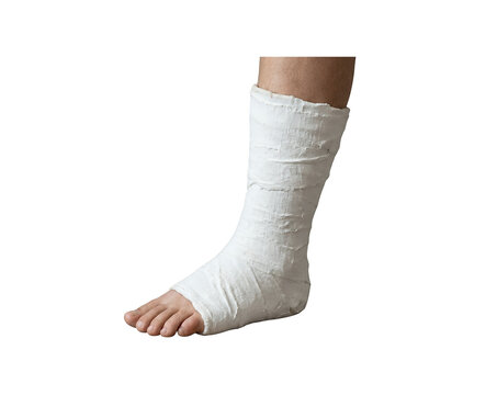 Medical plaster cast on injured foot and ankle, white orthopedic fiberglass bandage for bone fracture, patient leg with surgical dressing for recovery isolated on Transparent Background