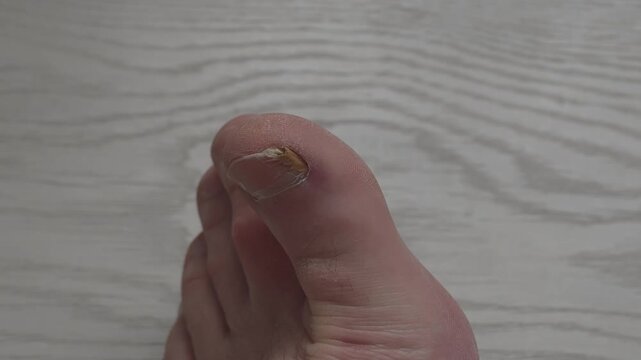 Close up view of a man's foot with a toenail affected by onychomycosis. Unpleasant fungal infection causing yellowing and thickening