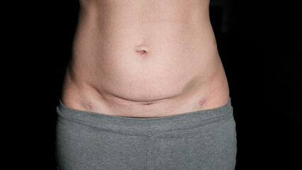 Naklejka premium Fresh medical scars on female abdomen after laparoscopic surgery. Stretch marks on light caucasian skin after cesarean section on dark background. Body Lymphatic edema. Maternity concept. Front view.