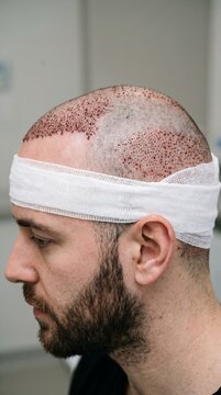 Side profile of a man after a hair transplant procedure with a bandage around his head.