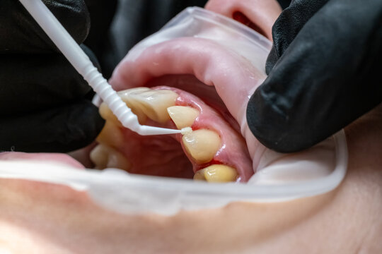 Dentist performing a professional dental procedure, carefully applying a substance to the patient's teeth and gums using a micro applicator, ensuring precise oral care and health