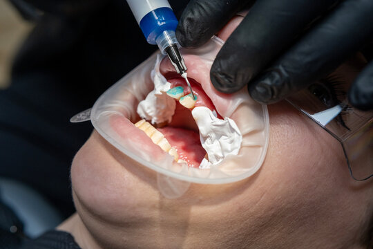 Dentist in black gloves applying a fluid bonding agent to a patient's front teeth during a dental procedure for oral health and cosmetic dentistry