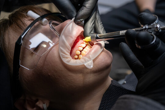 Dentist administering painless local anesthesia to a patient with a mouth retractor and safety glasses, preparing for a medical procedure in a dental clinic