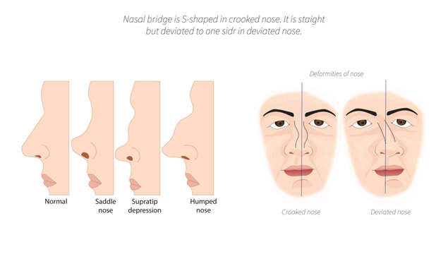 Nasal Deformities- Crooked Nose, Deviated Nose and Saddle Nose, common external nasal deformities, including crooked nose, deviated nose, saddle nose, supratip depression, and hump nose.
