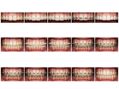 Dental braces progression showing teeth alignment before and after treatment mouth