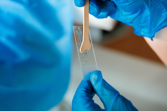Close-up of cervical sample being smeared on glass slide
