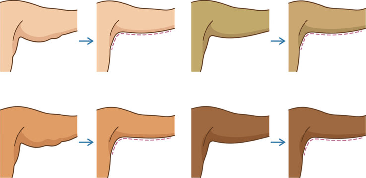 Arm lift surgery before and after vector diagram showing loose skin reduction brachioplasty results across different skin tones infographic