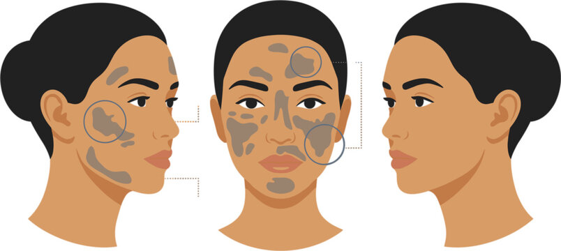 Melasma skin condition vector infographic showing hyperpigmentation patches on woman face from front and profile views for dermatological analysis