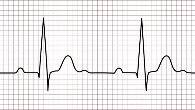 Black heart beat line on a medical grid paper graph showing a single pulse wave rhythm for health monitoring and cardiology diagnosis documentation in a hospital emergency room setting for analysis