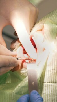 Dentist using surgical pliers to remove a decaying tooth in stomatology room